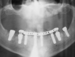 Figure 26  Panoramic radiograph taken 4 days after surgery, confirming seating of provisional. Site Nos. 18 and 31 were left unloaded during the healing phase.