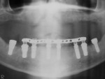 Figure 27  Panoramic radiograph taken 3 months after surgery. Reverse torque at 35 Ncm for each implant confirmed excellent secondary bone healing of SLActive implants.