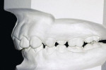 Figure 1 Maximum intercuspal position. This premise assumes that in a maxillary deficiency, the musculature compensates by holding the mandible in an altered posture to maximize dental contact.