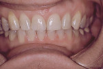 Figure 6 Examples of the ability of these treatment systems to address significant Class II malocclusions in both adolescent and adult populations with a non-extraction, non-surgical approach: Adolescent with Class II malocclusion, pretreatment (3); same