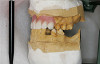 Fig 4. Age 10. Occlusal view of maxillary ridge.