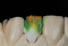 Fig 3. Preoperative view showing erosion of palatal surfaces of upper anteriors.