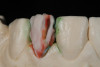 Fig 5. Wax-up for restoration of palatal erosion.
