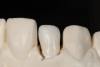 Fig 9. Smile view with provisional facial veneers.