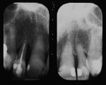 Figure 2  Pretreatment radiograph. Note severe vertical periodontal defect between the lateral incisors and adjacent teeth.