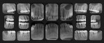 Figure 3  Pretreatment full-mouth radiographs showing the apical pathology on teeth Nos. 2 and 15, mesial bony defect on tooth No. 15, and the condition and size of patient’s pre-existing restorations.