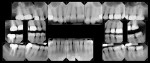 Figure 9  Final treatment full-mouth radiographs showing apical healing of the lesions on teeth Nos. 2 and 15 as well as the fit of the final restorations.