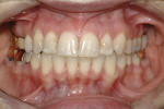 Figure 12  Post-orthodontic photograph shows coronal gingival level and bony exostosis on the buccal of tooth No. 3.