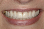 Figure 15  Posttreatment smile shows improved gingival levels and cosmetic improvement of the teeth.