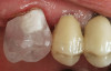 Figure 5 Palatal abscess due to non-vitality of tooth No. 8.