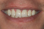 Figure 11 Full smile close-up after treatment; note increased display as patient now smiles unrestricted.