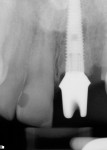 Figure 5 Radiograph following immediate placement of implant and abutment.