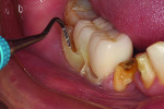 Figure 2 Ease of excess cement removal makes eCEMENT an ideal choice for lithium disilicate restorations.