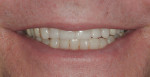 Figure 12 Close-up smile after treatment; note symmetry of arches.