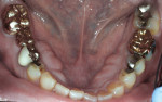 Figure 4 Mandibular occlusal view before treatment showed failing dental restorations placed more than 30 years ago; note the significant mandibular tori and asymmetric arch form.