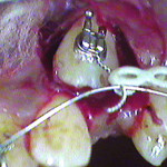 Figure 2 and Figure 3 After exposing the unerupted canine, an orthodontic bracket was bonded to the tooth.