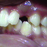 Figure 1 Patient’s maxillary left canine was missing and a bulge was present on the buccal side of canine region.