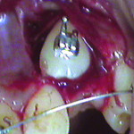 Figure 2 and Figure 3 After exposing the unerupted canine, an orthodontic bracket was bonded to the tooth.
