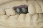 Figure 4 CAD/CAM milled copings for cemented crowns ready for porcelain application seated upon CAD/CAM titanium abutments.