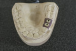 Figure 8 Zirconia CAD/CAM custom abutments that will accept ceramic cementable crowns.