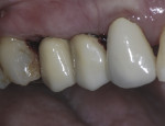 Figure 11 Buccal view of monolithic screw retained implant crowns.