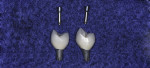 Figure 15 Screw retained
porcelain fused to titanium single implant
restorations.