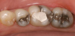 Patient presented with sensitive posterior teeth caused by old and defective amalgam restorations.