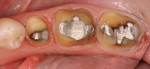 The posterior teeth were prepared for
full-contour zirconia restorations.