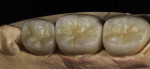 After the full-contour zirconia restorations were sintered, all incisal and dentin shading was integrated internally into the restoration.