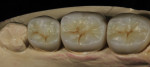 External stains were applied to the restorations for additional esthetic characterization.
