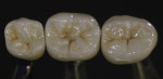 Final full-contour zirconia restorations were polished to a “pearl-like” sheen to achieve final esthetics.