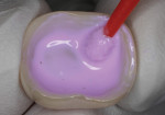 The intaglio surfaces of the zirconia
restorations were cleaned (Ivoclean, Ivoclar
Vivadent) in preparation for final cementation.