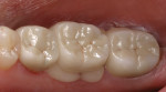 The final full-contour zirconia restorations were cemented, and excess cement was removed.