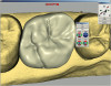 Fig 6. Completed diagnostic wax-up for maxillary and mandibular All-on-4 full-arch rehabilitation.