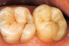 Fig 19. Patient smile shown 3 years post-treatment.