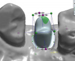 Figure 21. The implant module in 3Shape Dental Designer is used for CAD.