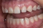Figure 3 Pretreatment views. Patient presented with darkening of tooth No. 8,
multiple diastemas, and an uneven gingival line.