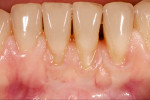 Figure 4. Overall tooth complex with disharmony between soft tissue and teeth.