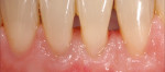 Figure 7. Outcome of treatment 1 year after
surgery. The harmony between teeth and
mucosa has been improved, resulting in better emergence profiles. Accordingly, the soft tissue offers better quality, greater stability, and more natural esthetics.