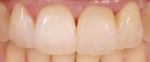 Figure 17. Four months after insertion, the mesially eccentric sulcus line of tooth No. 11 could be optimally imitated. Also, the distal papilla had gained additional stability and volume.