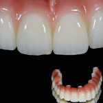 Figure 1 Burbank Dental Laboratory offers three distinct options when choosing a screw-retained hybrid-type prosthesis.