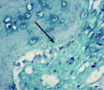 Figure 1 Biopsy report for NanoGen with Masson’s trichome stain at 40X: The newly formed bone is bluish green in color, which can differentiate it from the parent bone. Arrow shows lining osteoblasts with red nucleus