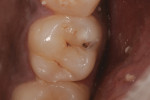 Figure 1 Preoperative photograph showing tooth No. 3 with occlusal decay.
