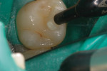 Figure 6 Bulk-fill posterior restorative was injected into the tooth in a single 4-mm increment.