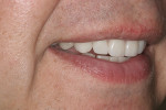 Final postoperative smile with IPS e.max crowns on teeth Nos. 6-11; veneers on teeth No. 22-27 will be phased in.