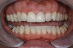The patient was pleased with the esthetics of the provisionals.
