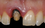Figure 3 Proper axial-gingival reduction was
completed, and initial gingival margin was placed coronal to the CEJ of adjacent central incisor.