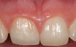 Figure 9 The clinical appearance of the definitive ceramic crown shown at 1 year post-treatment. Note the position and contour of the free gingival margins and absence of clinical inflammation.