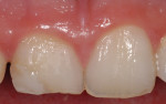 Figure 6 Right central incisor had a deficient composite restoration and palatal caries requiring a full crown restoration.
