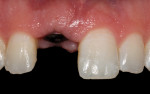 Figure 14 The gingival frame before placement of the definitive implant-supported ceramic
restoration demonstrated deficient papillae height.